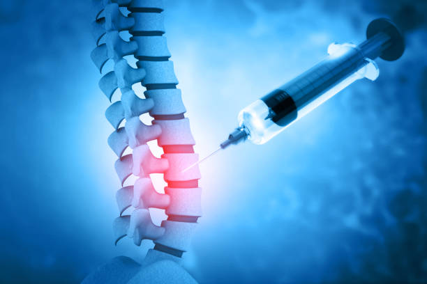 3d illustration d'une injection de la colonne lombaire